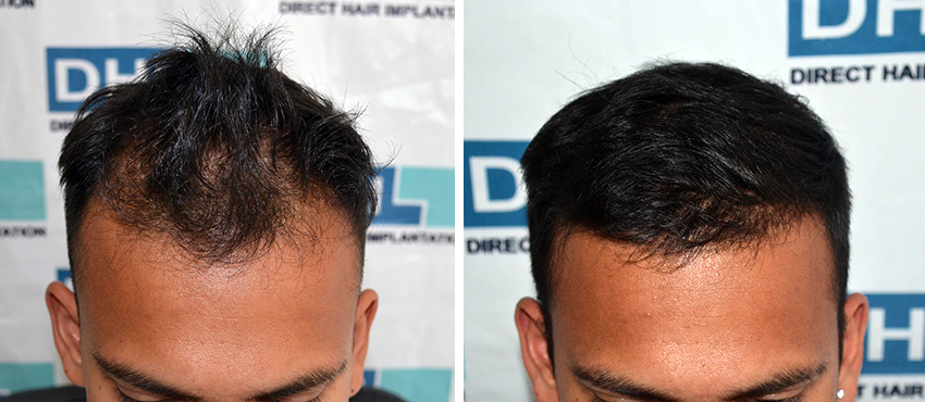 DHI before & after hair transplant results